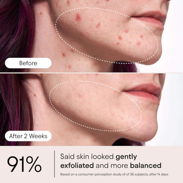 2% Salicylic Acid Liquid Exfoliating Toner For Pores, Blemishes & Brighter Skin