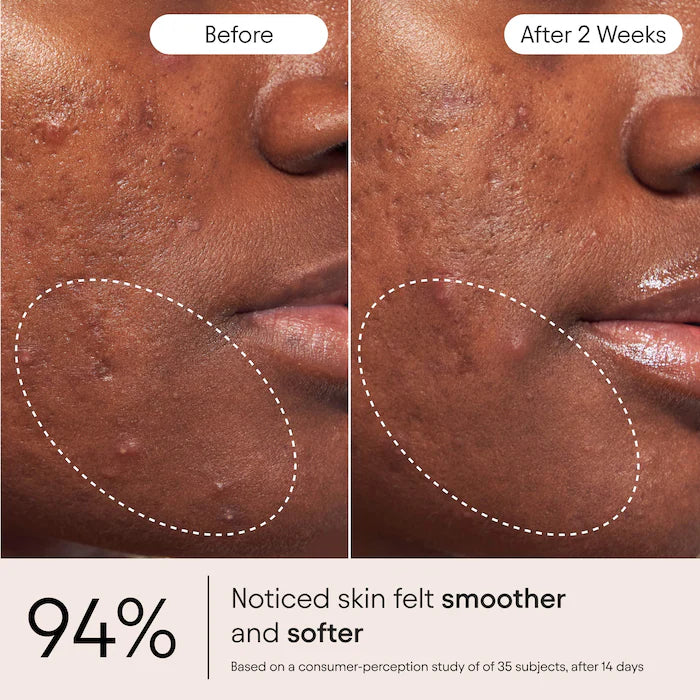 2% Salicylic Acid Liquid Exfoliating Toner For Pores, Blemishes & Brighter Skin