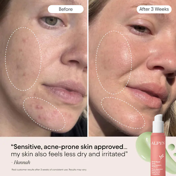 3-In-1 Barrier Repair Serum With Azelaic Acid For Hyperpigmentation, Firming & Redness Relief
