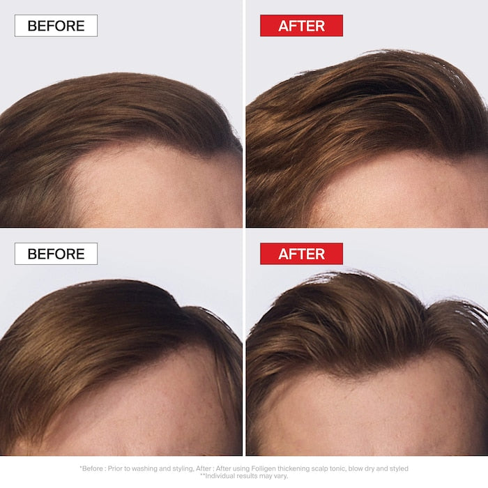 Folligen Thickening Scalp Tonic For Thinning Hair