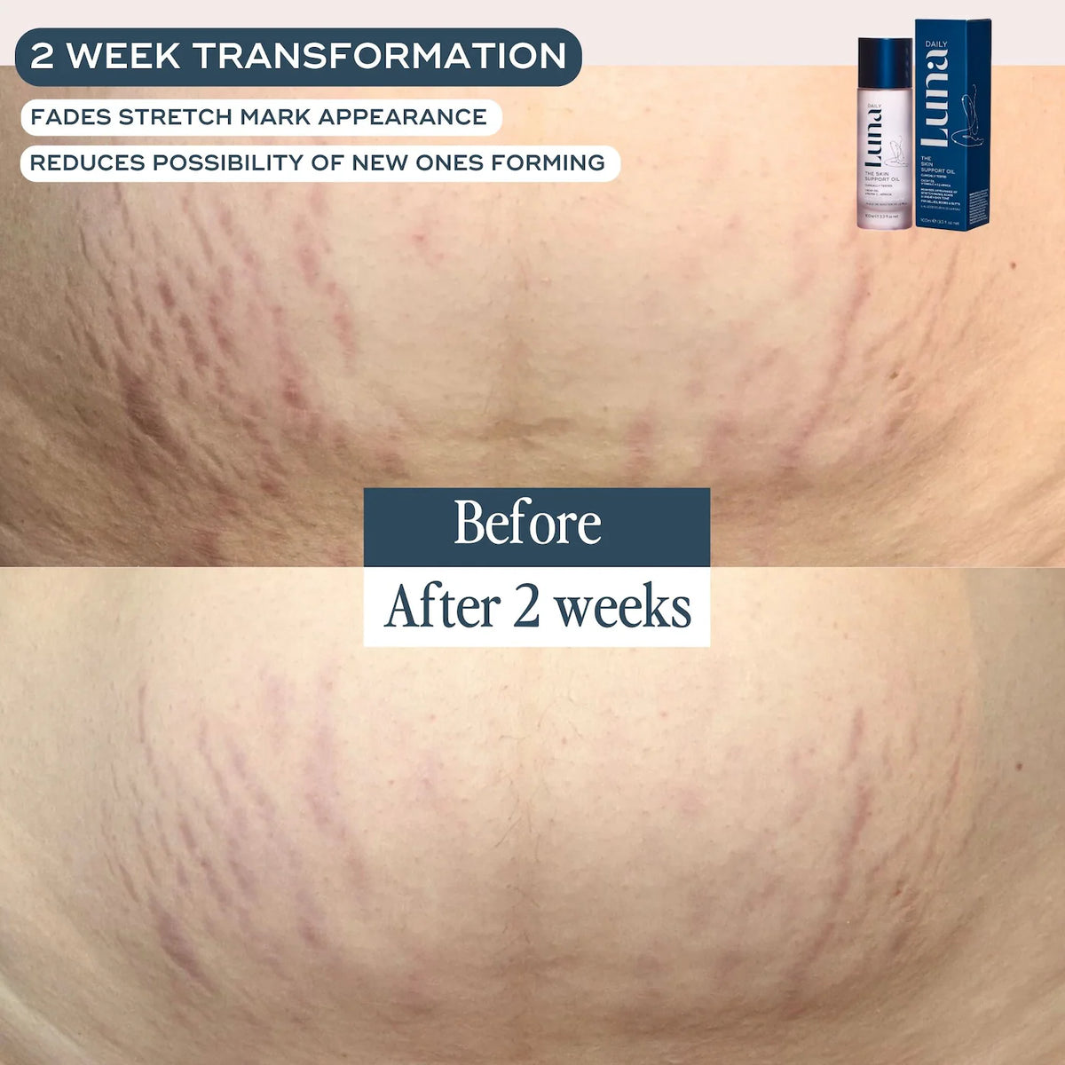 The Skin Support Oil For Stretch Marks - Azora Beauty