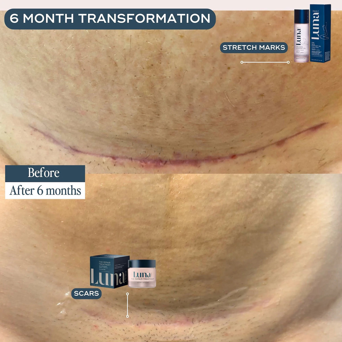 The Skin Support Oil For Stretch Marks - Azora Beauty