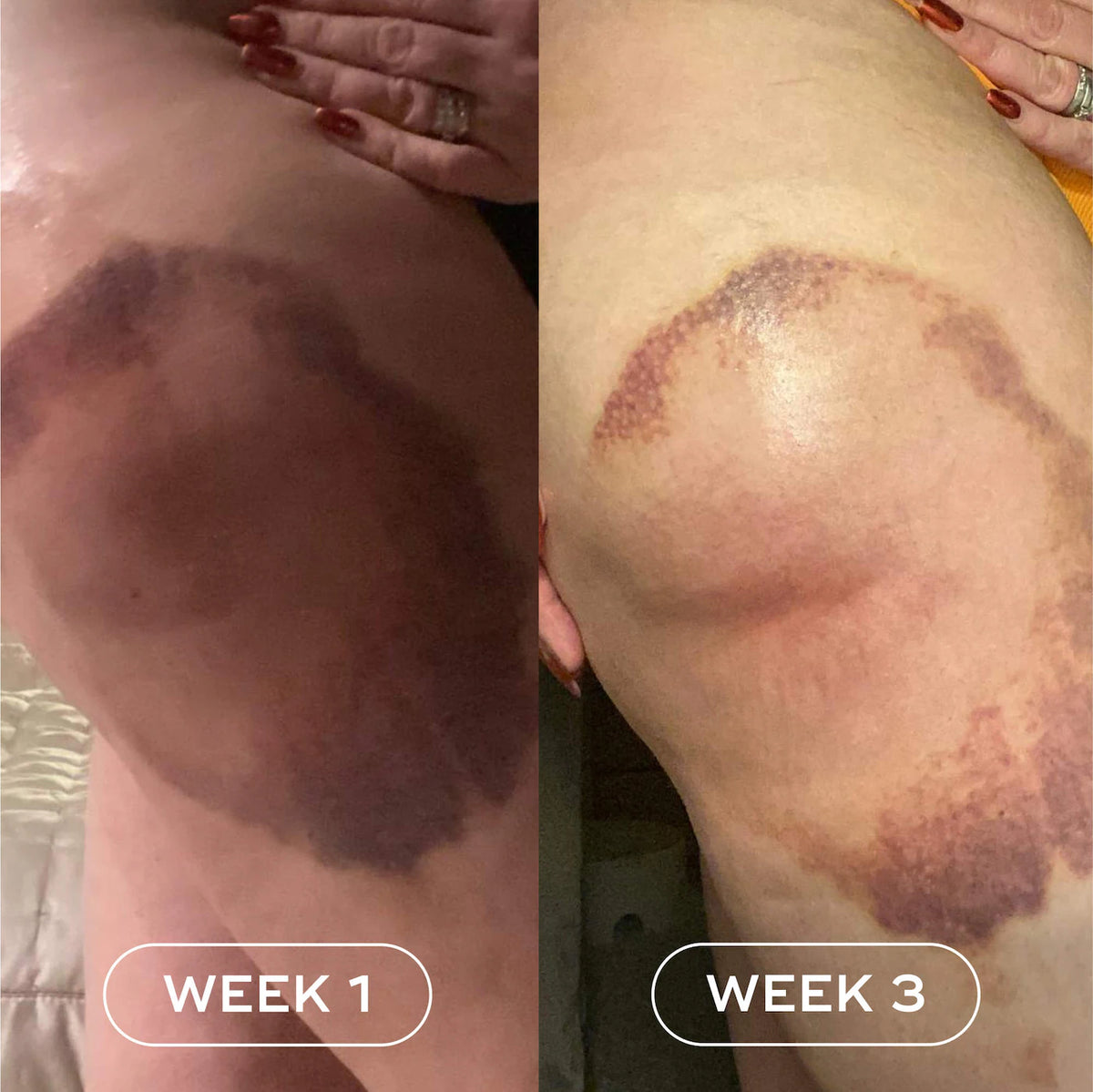 The Skin Support Oil For Stretch Marks - Azora Beauty