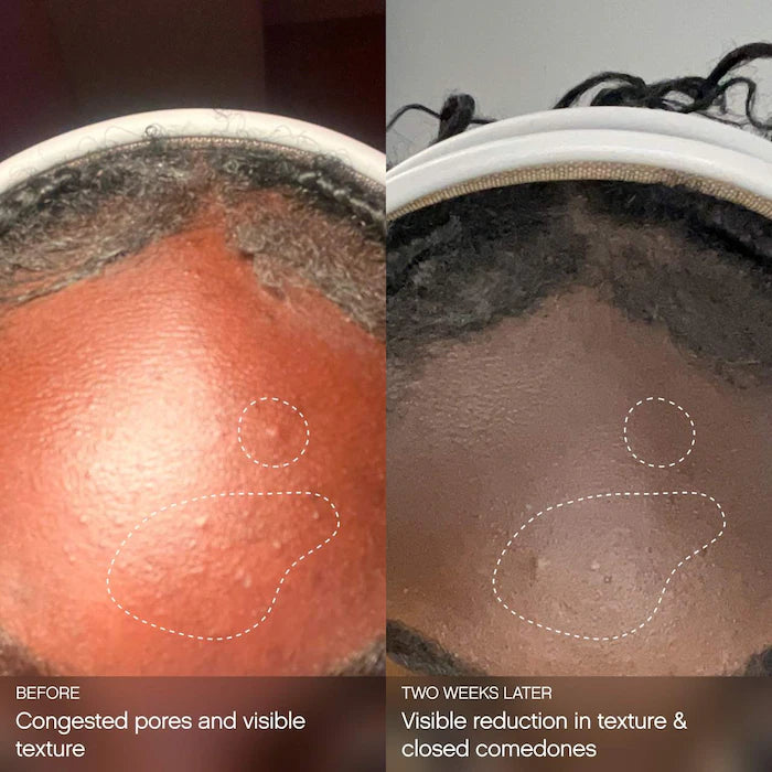 Clearly Clarifying & Calming Mist For Acne-Prone Skin