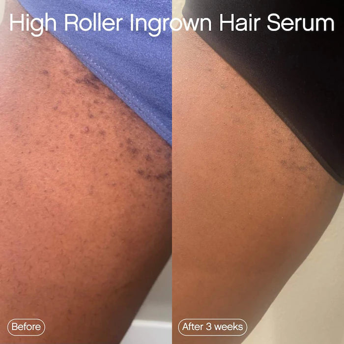 High Roller Ingrown Hair Tonic With AHA And BHA