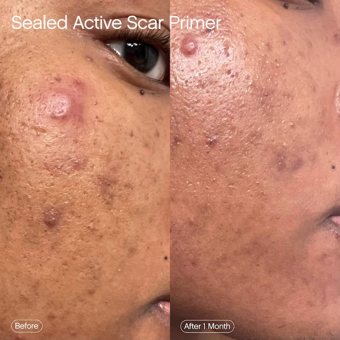 Sealed Active Scar Filling Primer For Acne Prone Skin